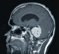 MRI - Base of Brain Tumour
