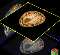 Functional Brain MRI