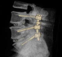 Spine Surgery