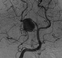 Vascualr Neurosurgery